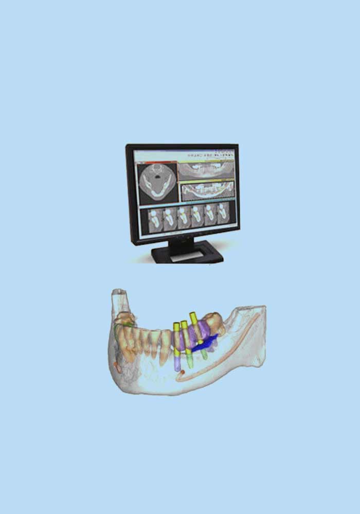 Chirurgia orale computer guidata: impianti senza bisturi né suture